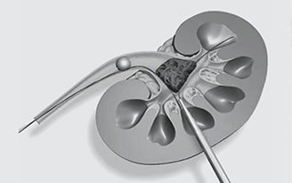 KIDNEY-STONE-MANAGEMENT-PCNL_MINIPERC