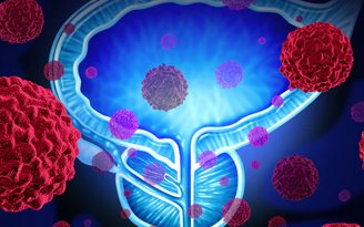 Prostate Cancer Treatment In Jaipur