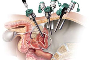 Prostate Surgery In Jaipur