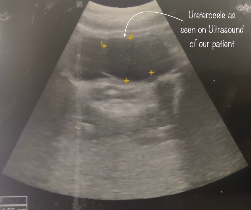 Ureterocele Treatment at Institute of Urology, Jaipur