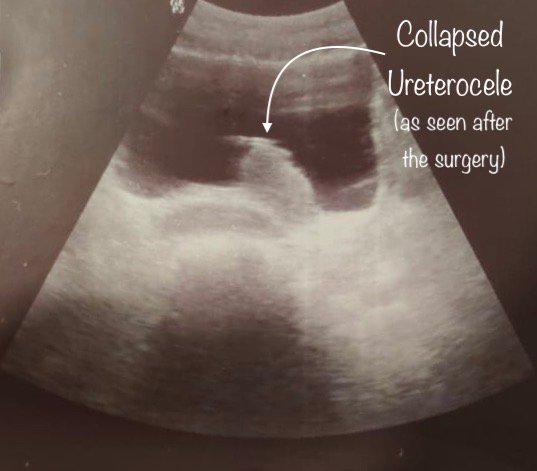 Ureterocele treatment at Institute of Urology, Jaipur Rajasthan