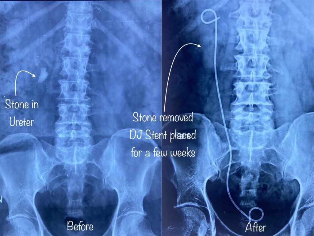 Best hospital for kidney ureter stone surgery in Jaipur