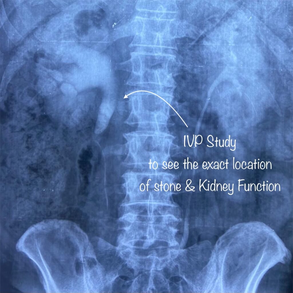 Stone in Upper Ureter Laser Treatment by Dr. Rajan Bansal Best Urologist in Jaipur Rajasthan