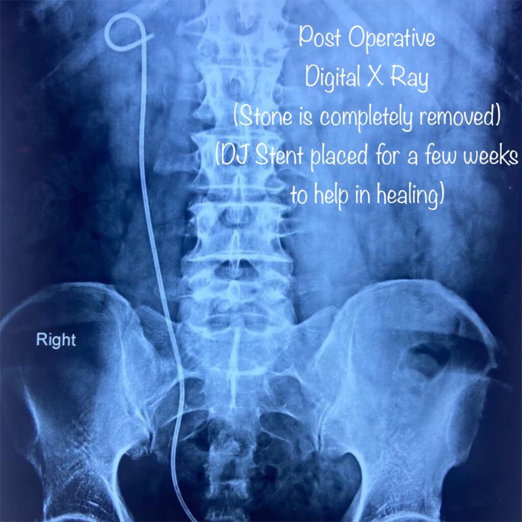 Stone in Upper Ureter Modern Laser Treatment by Dr. Rajan Bansal Best Urologist in Jaipur Rajasthan