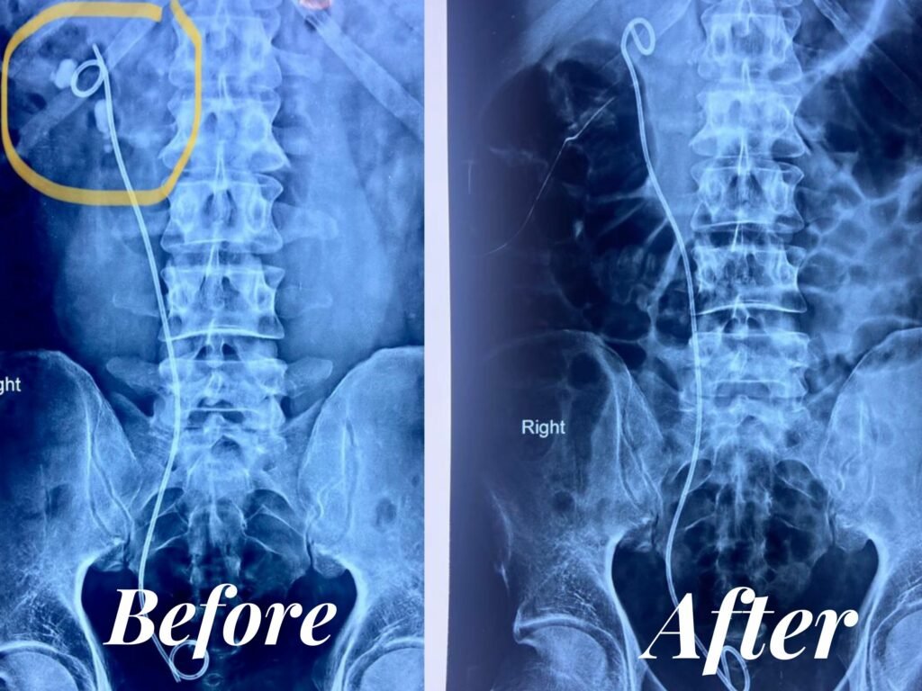 Best doctor for kidney stone treatment in Jaipur Dr. Rajan Bansal without or with surgery minimally invasive surgery with medicines