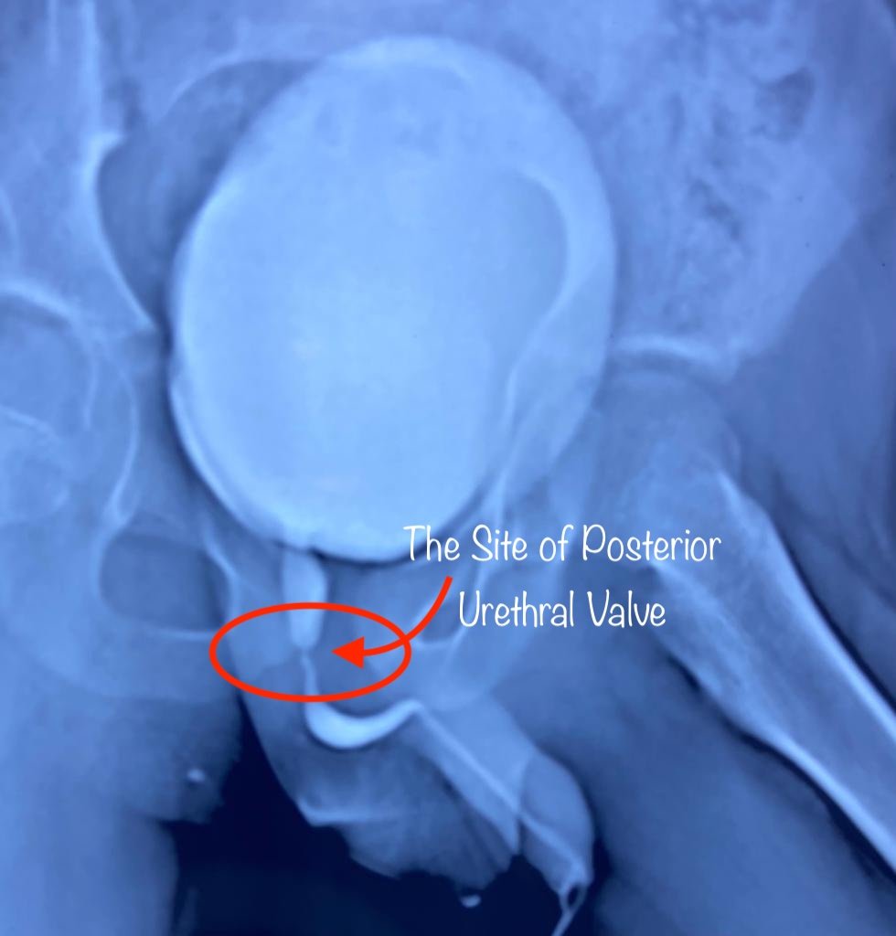 Posterior Urethral Valve Treatment at Institute of Urology, Jaipur Dr Rajan Bansal