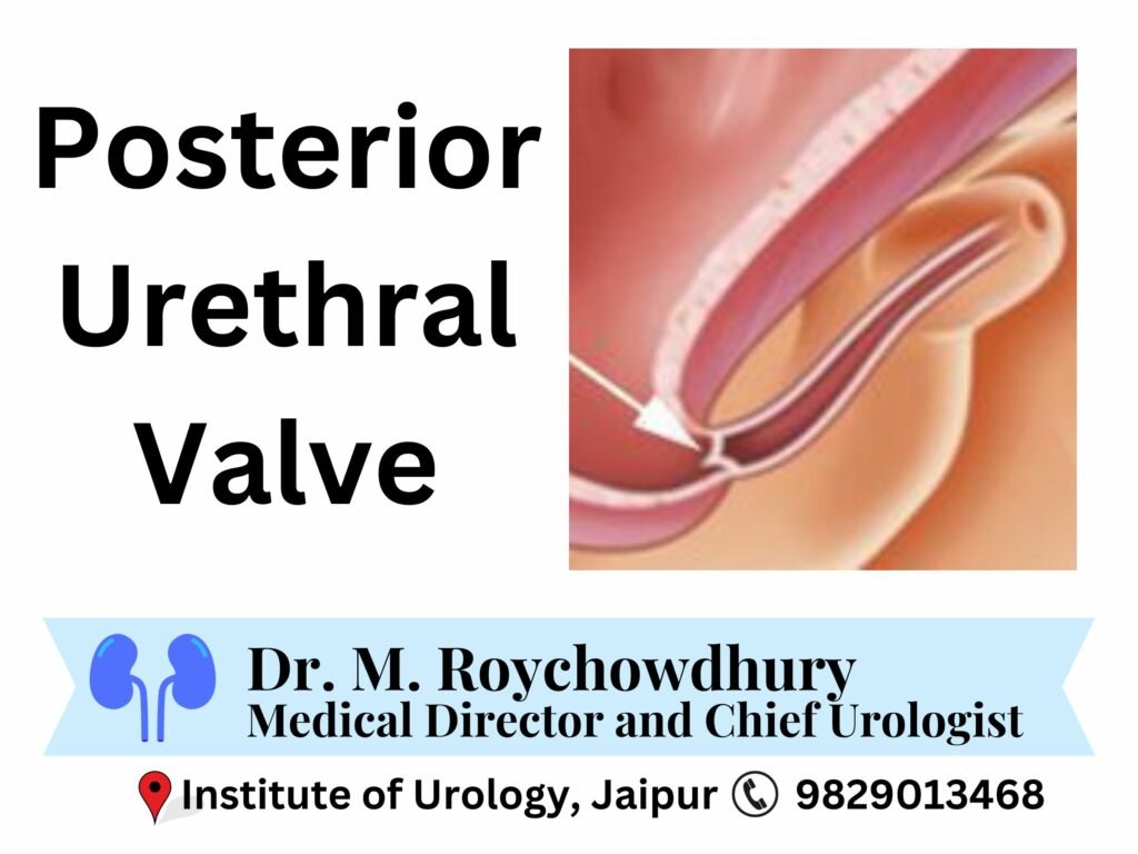 Posterior Urethral Valves Best doctor surgeon for child in Rajasthan Jaipur Dr. Rajan Bansal