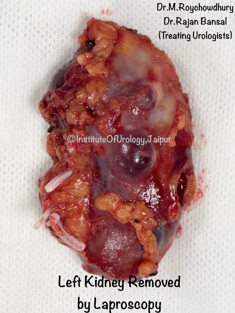 Renal Artery Stenosis Treatment by Dr Rajan Bansal Institute of Urology, Jaipur