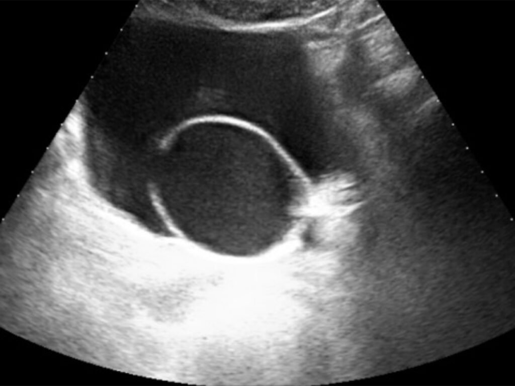 Large Ureterocele USG Dr. Astha Bansal