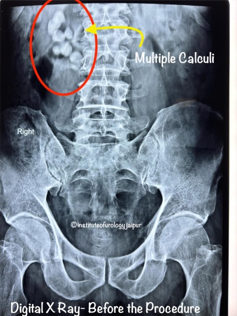 Kidney Stones X Ray Treatment by Dr. Rajan Bansal C Scheme Jaipur