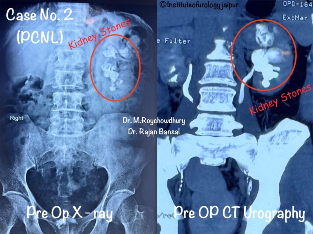 Renal Stone Treatment in Jaipur Dr. M Roychowdhury Dr Rajan Bansal Institute of Urology C Scheme