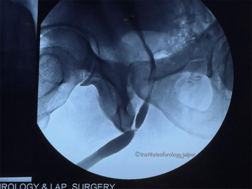 Urethral Stricture Treatment best doctor in jaipur rajasthan India Dr M Roychowdhury Dr Rajan Bansal Urologist