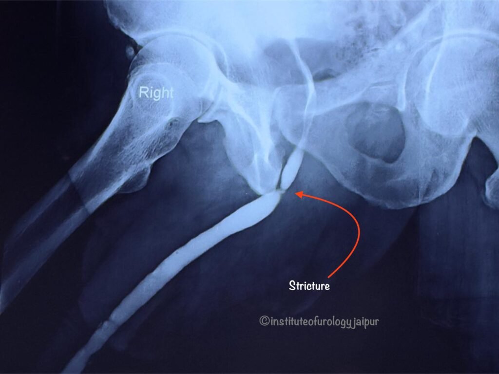 Urethral Stricture best doctor in jaipur rajasthan India Dr M Roychowdhury Dr Rajan Bansal Urologist