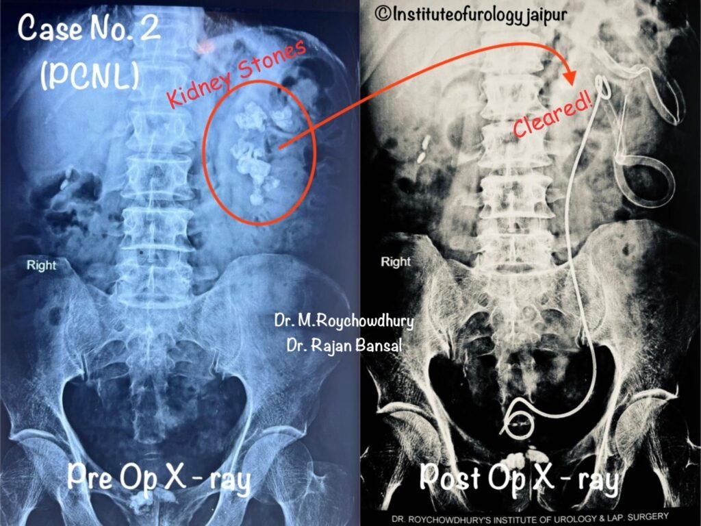 kidney Stone Treatment Jaipur Dr. M Roychowdhury Dr Rajan Bansal Institute of Urology C Scheme
