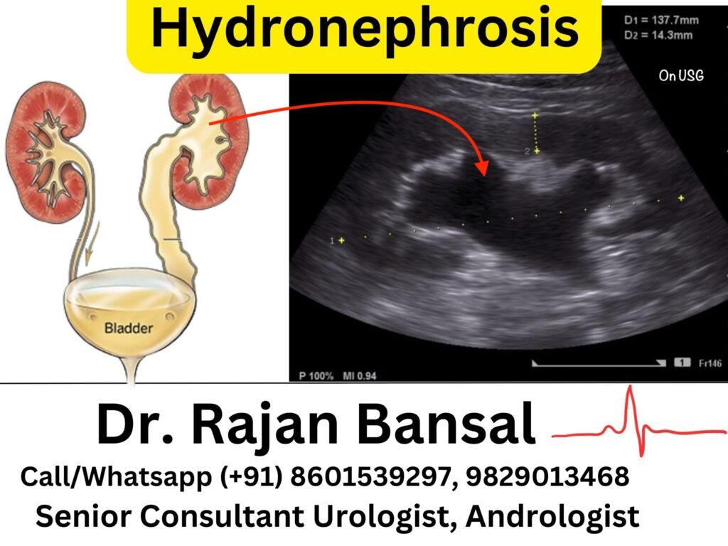 Hydronephrosis Treatment Best Doctor Hospital in Jaipur Rajasthan Dr Rajan Bansal Dr M Roychowdhury
