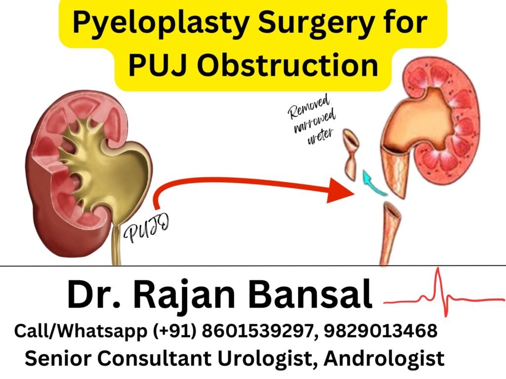 Anderson-Hynes Pyeloplasty Surgery for PUJ Obstruction Dr Rajan Bansal Dr M Roychowdhury Best Urologist in Jaipur Rajasthan