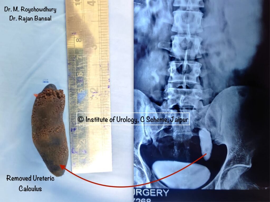 Large Lower Ureteric Calculus Image Dr M Roychowdhury Dr Rajan Bansal