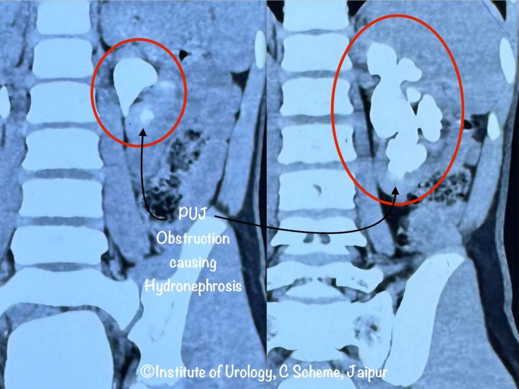 PUJ Obstruction treatment at Institute of Urology Jaipur Dr M Roychowdhury Dr Rajan Bansal