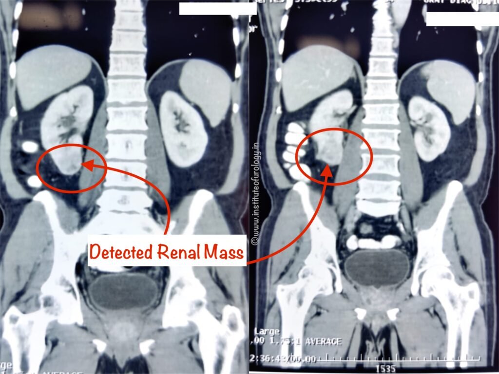 Partial Nephrectomy for Small Renal Tumour at Institute of Urology, Jaipur