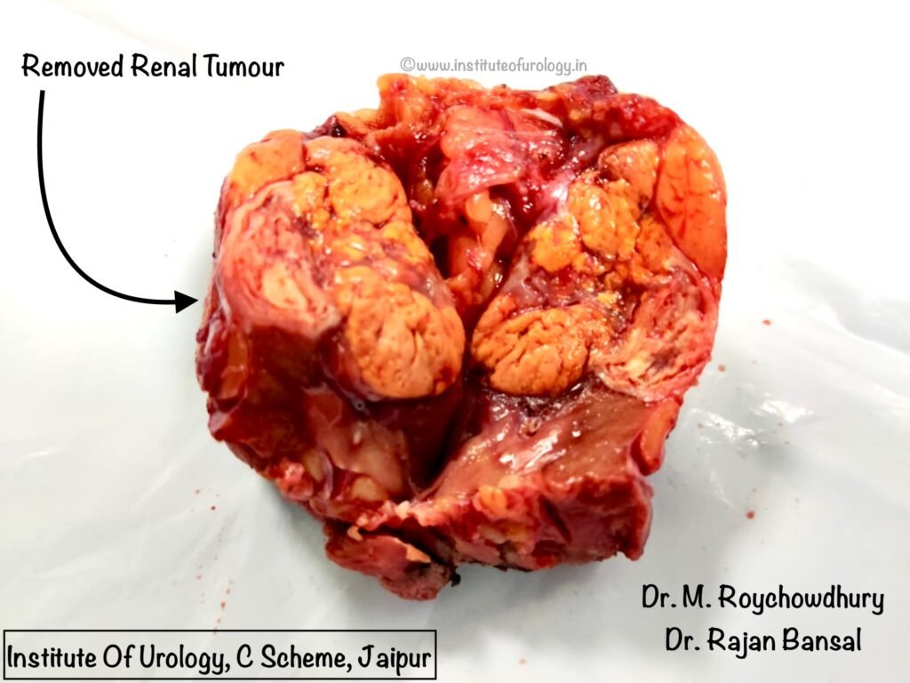 Partial Nephrectomy for Small Renal Tumour at Institute of Urology, Jaipur Dr M Roychowdhury Dr Rajan Bansal