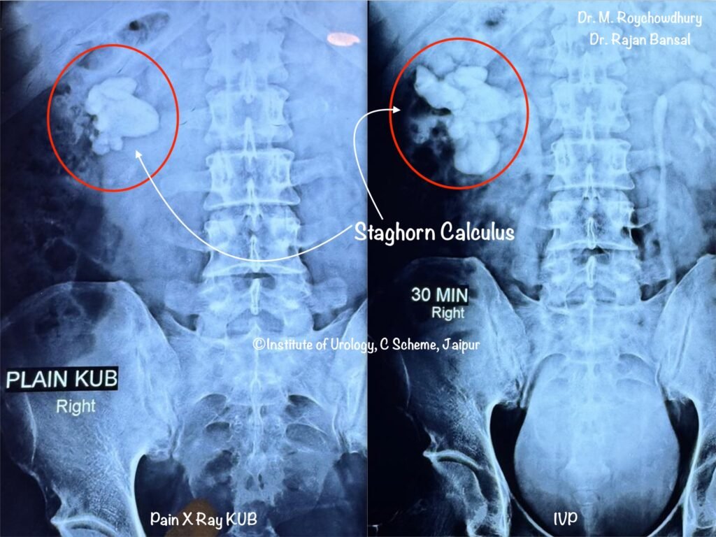 Staghorn Calculus X ray IVP Dr M Roychowdhury Dr Rajan Bansal