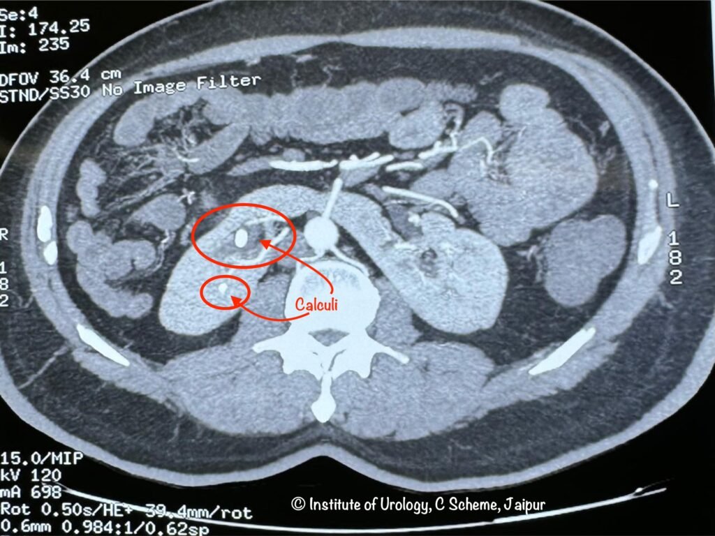 Stone in horseshoe kidneys CT Images