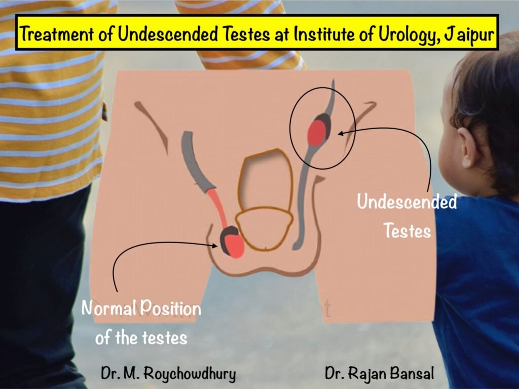 Undescended Testes Treatment at Institute of Urology, C Scheme, Jaipur