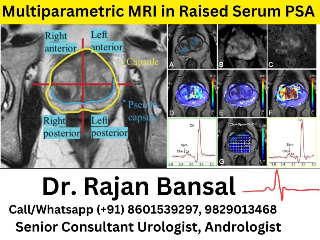 Importance of Multi-Parametric MRI in Raised Serum PSA
