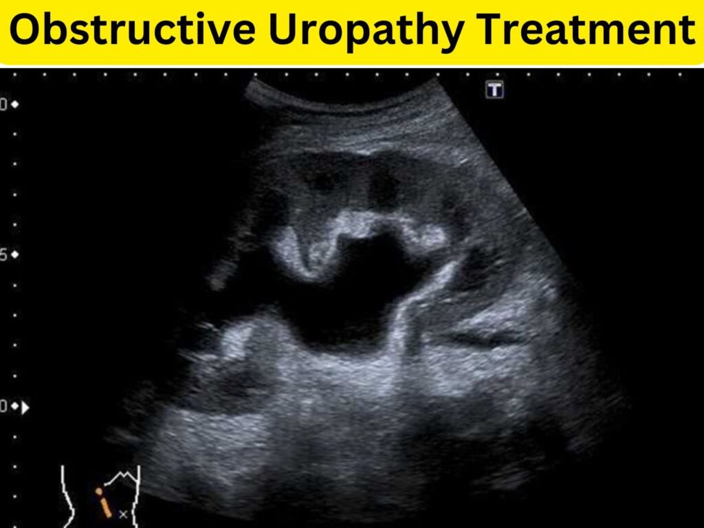 Obstructive Uropathy Treatment at Institute of Urology, Jaipur
