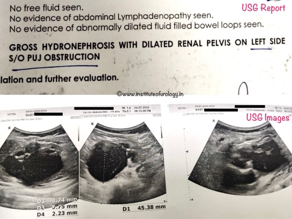PUJ Obstruction Treatment by Pyeloplasty at Institute of Urology, Jaipur