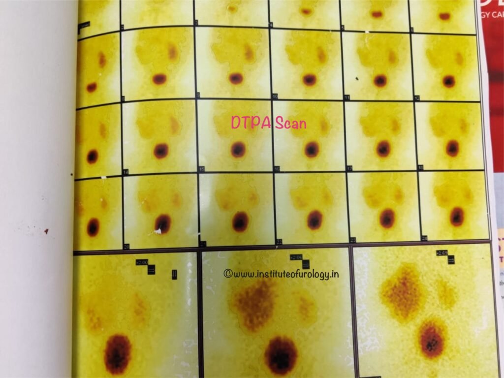 PUJ Obstruction Treatment by Pyeloplasty at Institute of Urology, Jaipur DTPA Scan