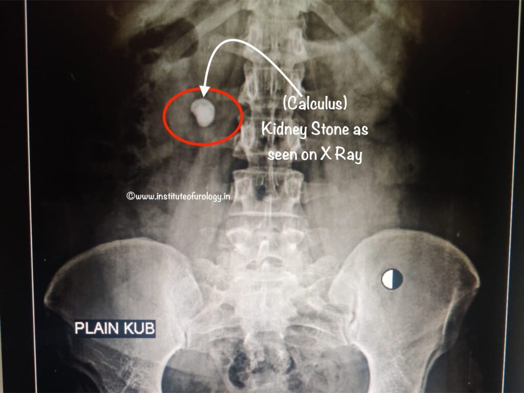 RIRS for a Large Renal Calculus at Institute of Urology, Jaipur