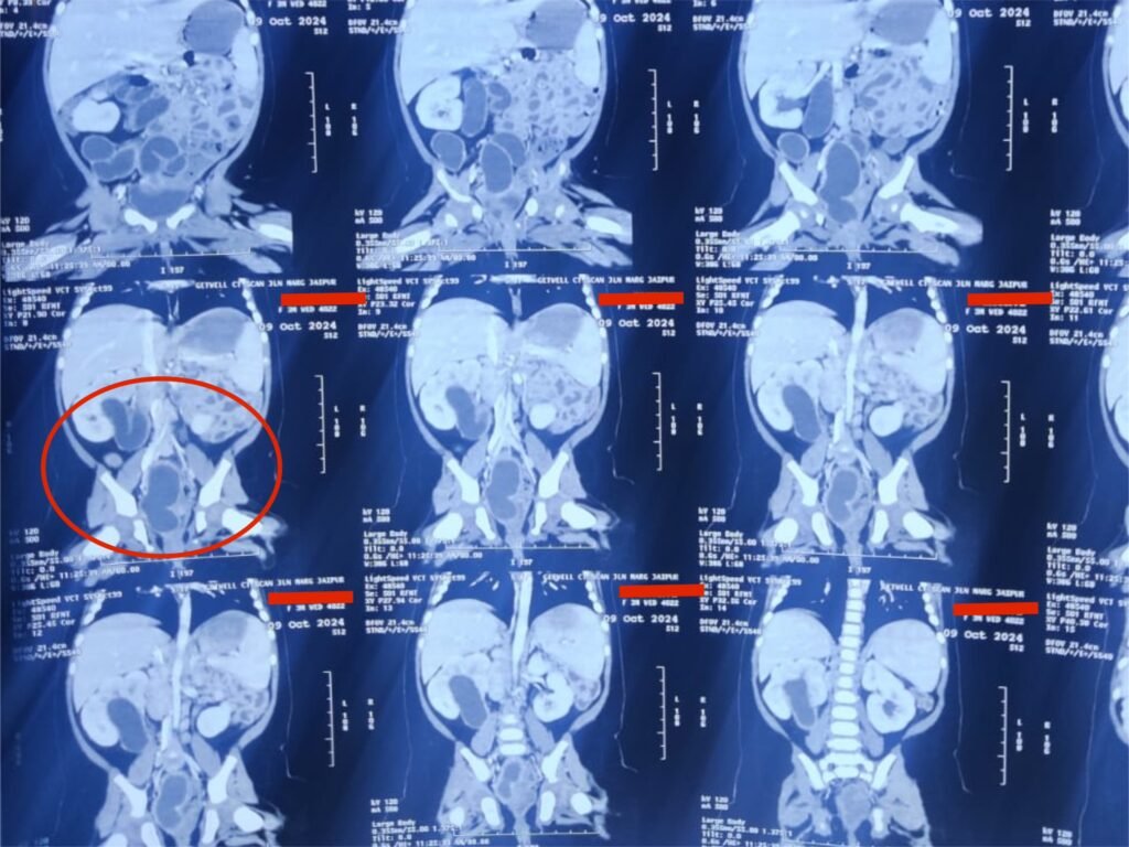 Ectopic Ureter and Duplex Collecting System in a 3 Month Old Baby Girl Institute of Urology, Jaipur
