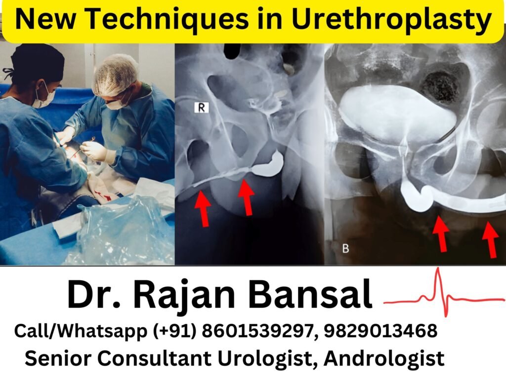 New Techniques in Urethroplasty- Innovations, Trends, and Recent Studies