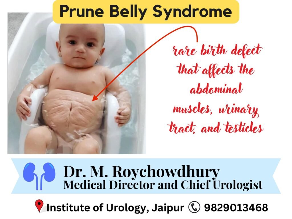 Prune Belly Syndrome- Diagnosis, Management, and Emerging Trends