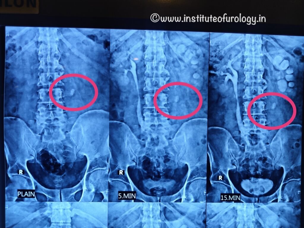 Management of Upper Ureteric Calculus with RIRS at Institute of Urology, Jaipur Dr M roychowdhury dr rajan bansal