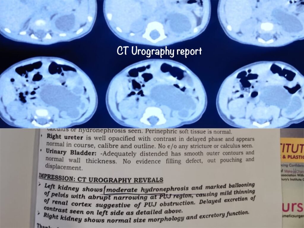 Antenatally Diagnosed Hydronephrosis in a 2.5-Month-Old Infant Treated by Pyeloplasty Institute of Urology, Jaipur