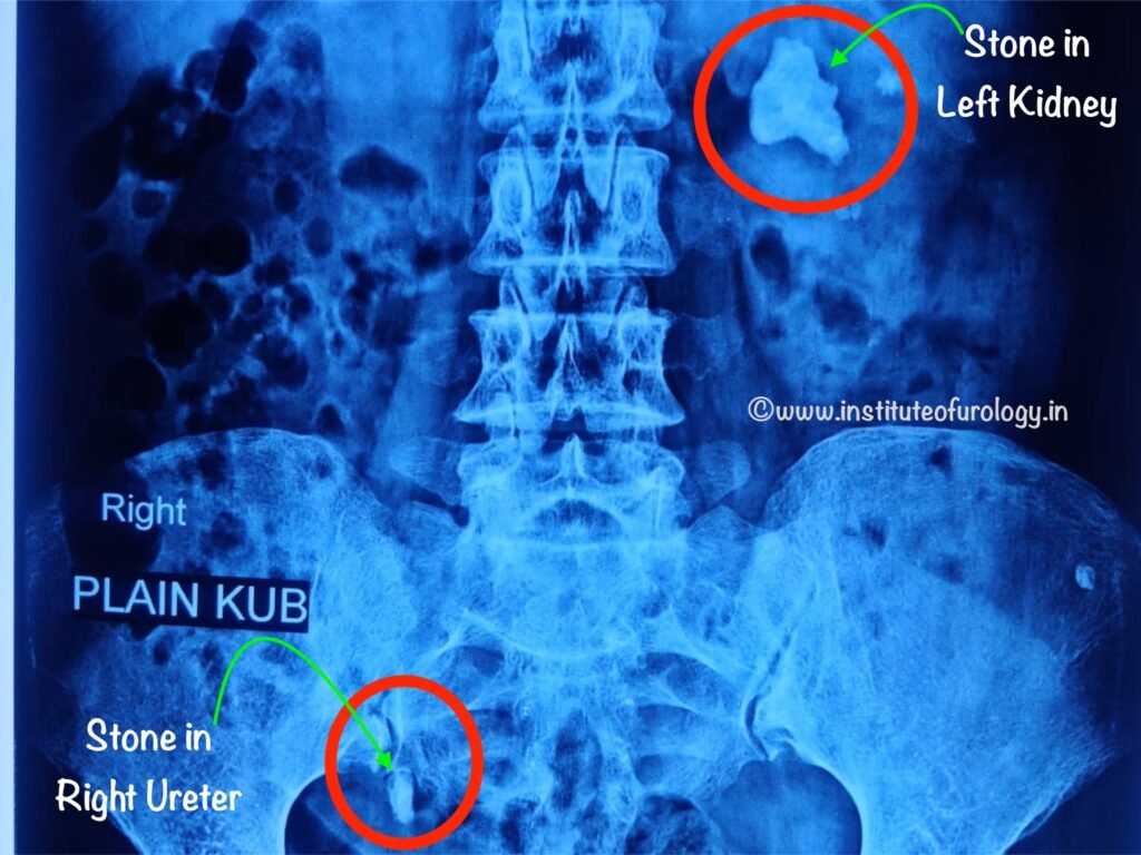 Dual Endoscopic Management of Bilateral Renal and Ureteric Calculi in an Elderly Patient at Institute of Urology, Jaipur Dr Rajan bansal Dr M Roychowdhury