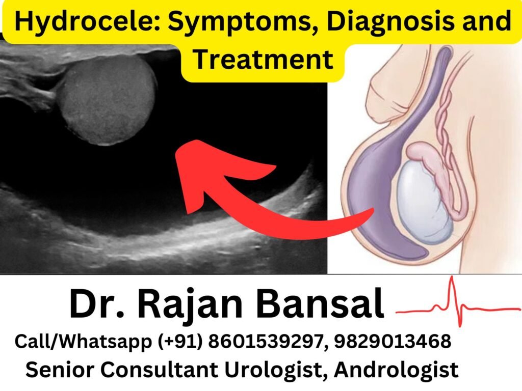 Hydrocele- Symptoms, Diagnosis and Treatment at Institute of Urology, Jaipur Dr M Roychowdhury Dr Rajan Bansal