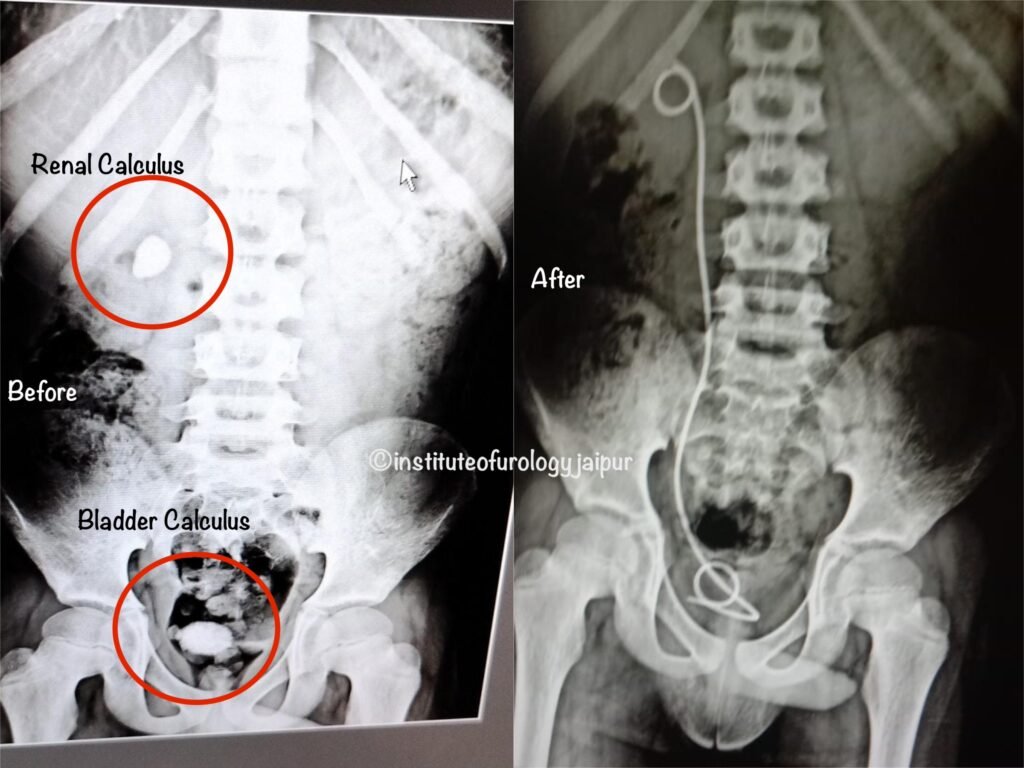 Urinary Bladder and Renal Calculi in a 10-Year-Old Child