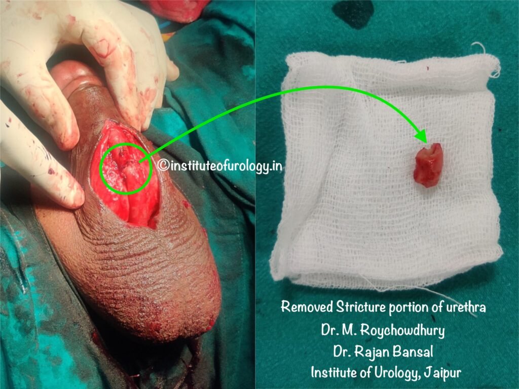 Best Hospital for Urethroplasty in Jaipur - Dr. M Roychowdhury Dr Rajan Bansal Best urologist