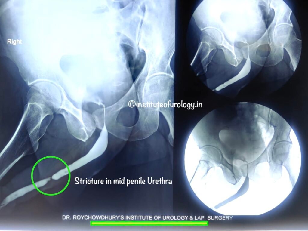 Best Hospital for Urethroplasty in Jaipur - Dr. M Roychowdhury Dr Rajan Bansal Best urologist RGU Image Stricture Urethra HD