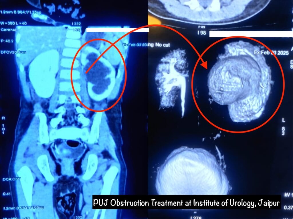 Pediatric PUJ Obstruction