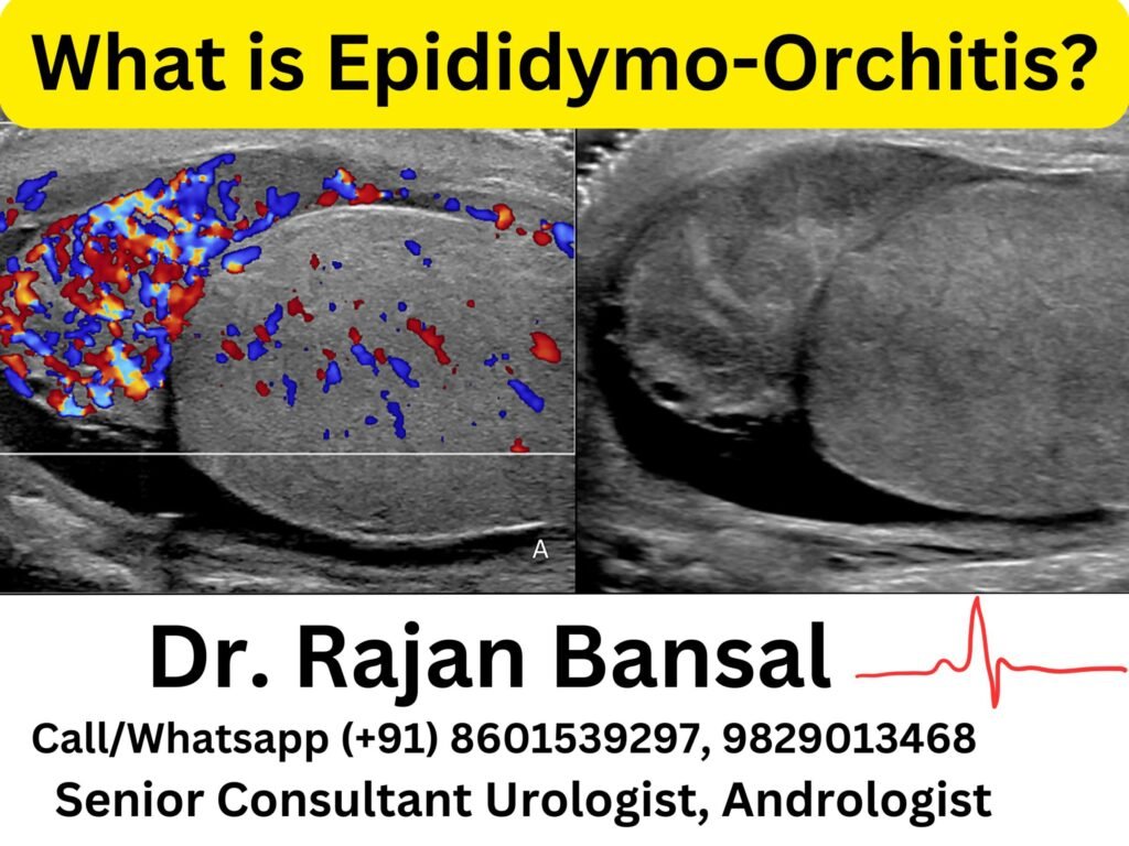 What is Epididymo-Orchitis? Dr. M Roychowdhury Dr. Rajan Bansal