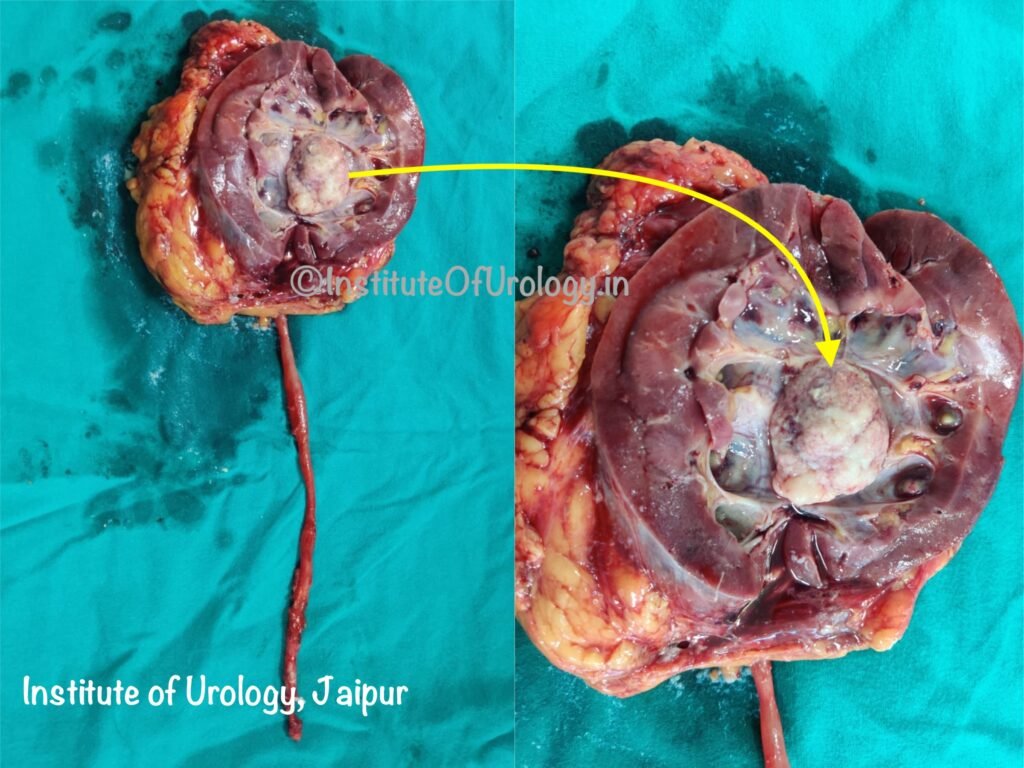 Best doctor hospital for Kidney Cancer Treatment at Institute of Urology, Jaipur Rajasthan