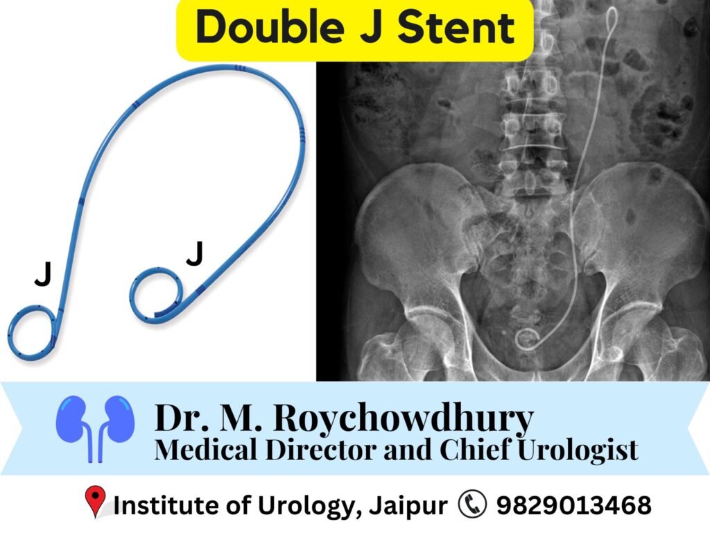 Double J Stent- What Is It and What to Expect After Placement Dr M Roychowdhury Dr Rajan bansal