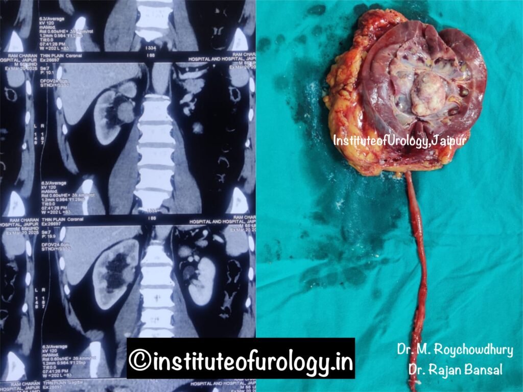 Kidney Cancer Treatment at Institute of Urology, Jaipur Dr M Roychowdhury Dr Rajan Bansal