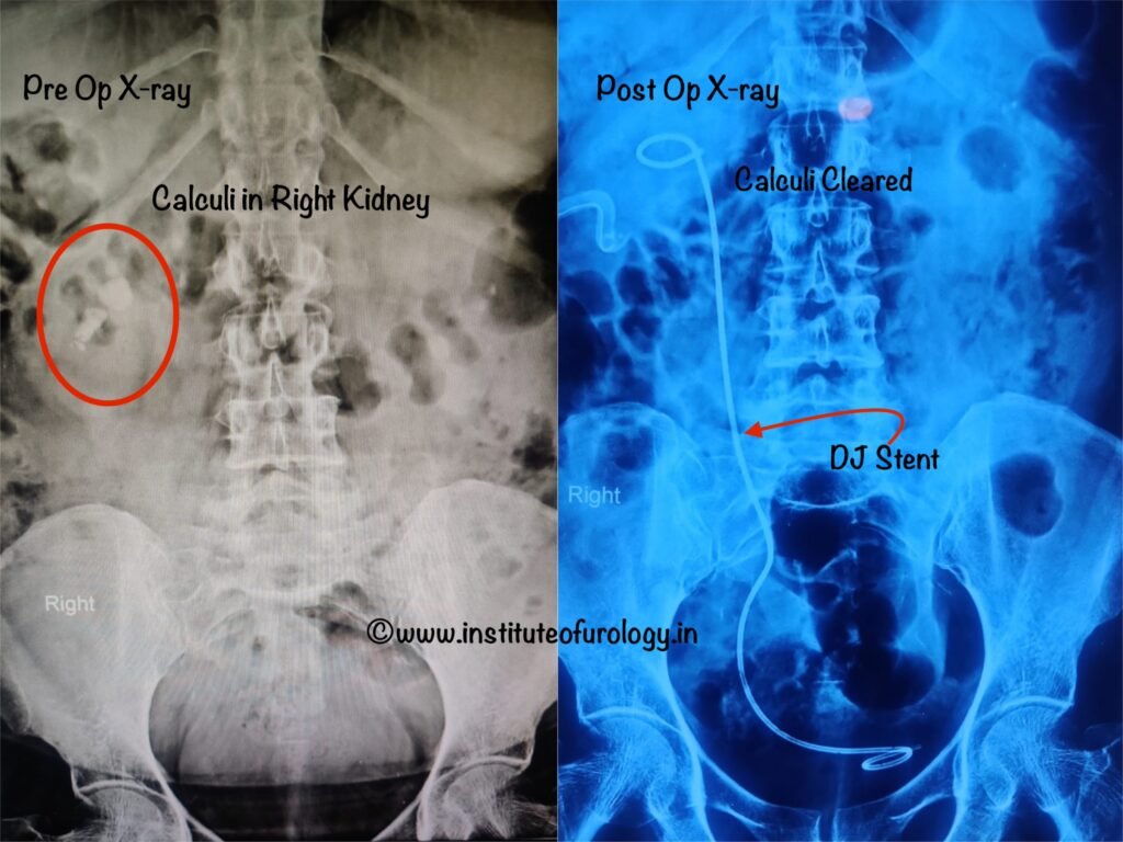 Large Kidney Stones Treatment by PCNL at Institute of Urology, Jaipur Dr. M Roychowdhury Dr. Rajan Bansal