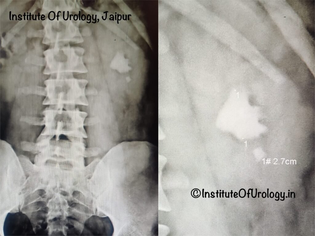 Staghorn Calculus Treatment by PCNL at Institute of Urology, Jaipur Dr M Roychowdhury Dr Rajan Bansal