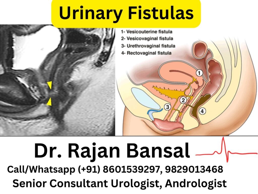 Urinary Fistulas- Causes, Diagnosis, and Surgical Repair Dr M Roychowdhury Dr Rajan Bansal